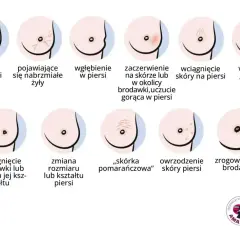 Ilustracja pokazuje różne zmiany w piersiach, w tym wyciek z brodawki, zaczerwienienie, wgłębienie, guzek, zmiany skórne i zrogowacenie.