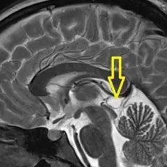 Przekrój mózgu z zaznaczonym strzałką obszarem szyszynki. Może to być pomocne w diagnostyce guz szyszynki objawy.