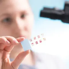 Naukowczyni analizuje próbki po biopsji gruboigłowej, oceniając wynik BIRADS 4 pod mikroskopem.