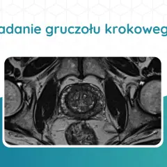 Badanie rezonansem magnetycznym: przekrój gruczołu krokowego, ocena wymiarów prostaty przy raku.