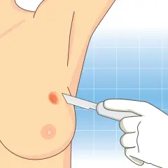 Wykonanie biopsji gruboigłowej piersi. Dłoń w rękawiczce trzyma skalpel przy podejrzanej zmianie na piersi.