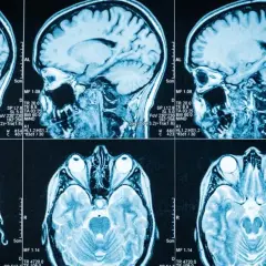Przekroje mózgu na rezonansie magnetycznym. Widoczne są różne płaszczyzny, w tym strzałkowa i osiowa, ukazujące szczegóły budowy mózgu. Badanie może pomóc w diagnostyce guzów podwzgórza i ich objawów.