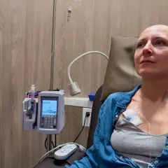 Kobieta po chemioterapii, która może być leczeniem raka jelita grubego. Przyczyny choroby są złożone.