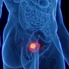 Anatomical illustration showing a glowing tumor within the bladder, representing nieinwazyjny rak brodawkowaty pęcherza moczowego.
