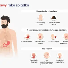 Ilustracja przedstawia objawy raka żołądka, w tym utratę masy ciała i czarne stolce. W zaawansowanych stadiach mogą pojawić się nudności, zgaga i trudności w połykaniu.