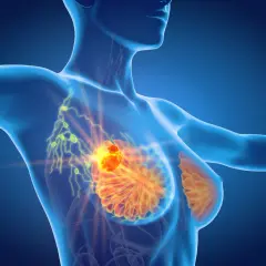 Anatomical view of a breast showing a tumor and affected wezly chlonne piersi.