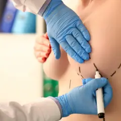 Chirurg zaznacza markerem piersi do operacji. Jedna pierś jest większa od drugiej po operacji.