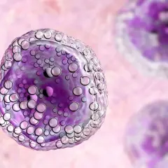 Komórki chłoniaka Burkitta u dzieci, widoczne pod mikroskopem, z licznymi pęcherzykami w cytoplazmie.