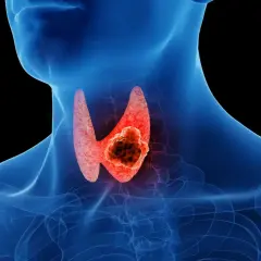 Anatomical illustration showing a human neck with a glowing red thyroid gland. A dark, irregular mass, representing rak brodawkowaty tarczycy, is visible within the gland.
