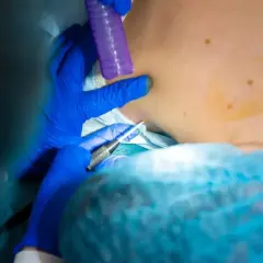 Lekarz w niebieskich rękawiczkach wykonuje biopsję aspiracyjną, pobierając próbkę tkanki z szyi pacjenta.