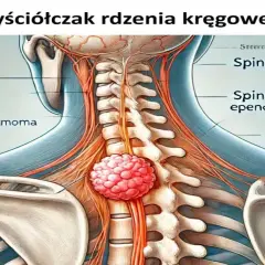 Anatomical illustration showing a tumor, labeled "ependymoma," growing on the spinal cord within the cervical vertebrae.