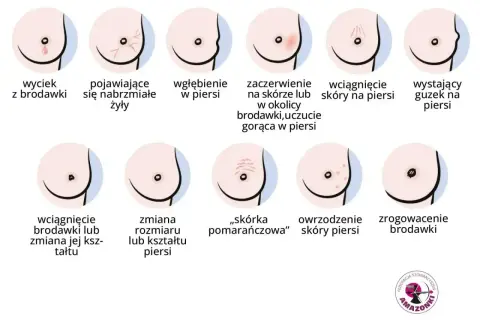 Ilustracja pokazuje różne zmiany w piersiach, w tym wyciek z brodawki, zaczerwienienie, wgłębienie, guzek, zmiany skórne i zrogowacenie.