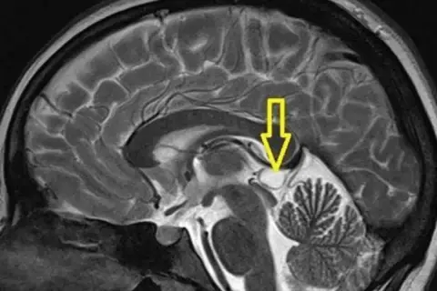 Przekrój mózgu z zaznaczonym strzałką obszarem szyszynki. Może to być pomocne w diagnostyce guz szyszynki objawy.