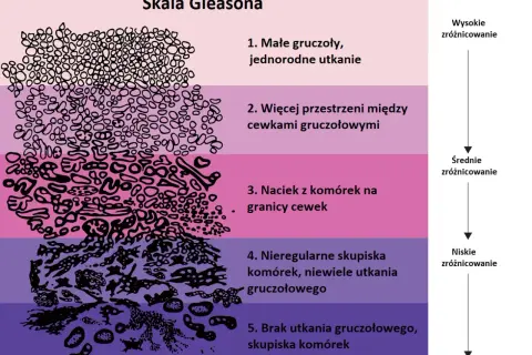 Skala Gleasona ilustruje stopnie zróżnicowania komórek w **adenocarcinoma prostatae gleason 7 (3+4)**, od małych gruczołów po naciek komórek.