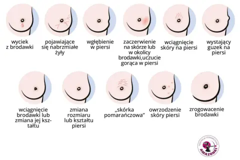 Ilustracja pokazuje objawy raka piersi, w tym wyciek z brodawki, wgłębienie, zaczerwienienie, zmiany skórne i guzek.