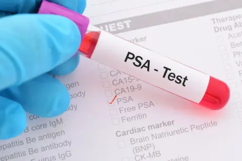 Rękawiczka w niebieskiej rękawiczce trzyma probówkę z napisem "PSA - Test". Zaznaczono pole "PSA", co może być związane z badaniem profilaktycznym prostaty.