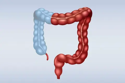 Ilustracja jelita grubego, gdzie prawa strona (czerwona) jest połączona z lewą (niebieską), symbolizując stan po hemikolektomii prawostronnej.