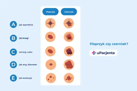 Ilustracja porównuje pieprzyk i czerniak, pokazując różnice w asymetrii, brzegach, kolorze, średnicy i ewolucji. Zwróć uwagę na czarną kropkę na sutku.