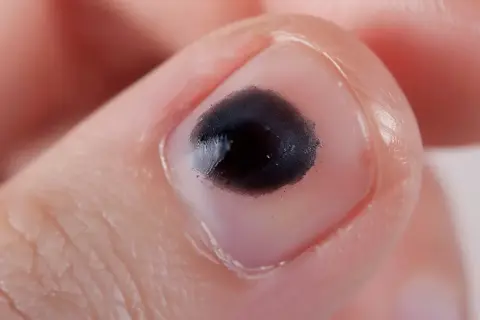 Intensywna, czarna kropka na paznokciu, otoczona skórą.