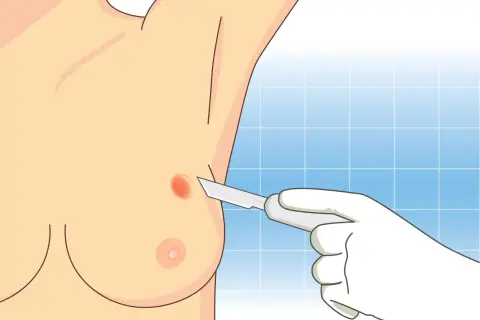 Wykonanie biopsji gruboigłowej piersi. Dłoń w rękawiczce trzyma skalpel przy podejrzanej zmianie na piersi.