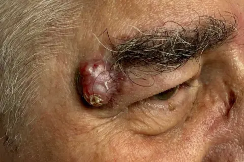 Zmiana skórna nad okiem, która może być nowotworem pierwotnym. Co to znaczy? To rak, który powstał w tym miejscu, a nie przerzut z innego narządu.