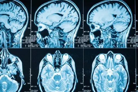 Przekroje mózgu na rezonansie magnetycznym. Widoczne są różne płaszczyzny, w tym strzałkowa i osiowa, ukazujące szczegóły budowy mózgu. Badanie może pomóc w diagnostyce guzów podwzgórza i ich objawów.