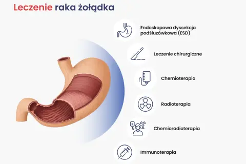 Nowoczesne leczenie raka żołądka obejmuje ESD, chirurgię, chemioterapię, radioterapię, chemioradioterapię i immunoterapię.