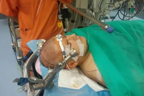 Pacjent przygotowany do operacji guza mózgu. Widoczny fragment głowy z zaznaczeniami i aparatura medyczna.