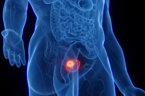 Anatomical illustration showing a glowing tumor within the bladder, representing nieinwazyjny rak brodawkowaty pęcherza moczowego.