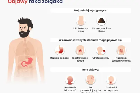 Ilustracja przedstawia objawy raka żołądka, w tym utratę masy ciała i czarne stolce. W zaawansowanych stadiach mogą pojawić się nudności, zgaga i trudności w połykaniu.