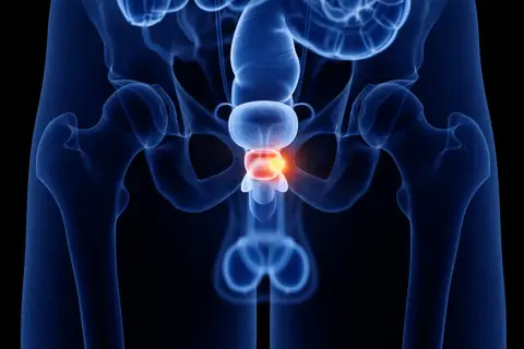 Anatomical illustration of the male pelvic region, highlighting the prostate gland with a glowing red area indicating cancer. This visual helps understand co niszczy raka prostaty.
