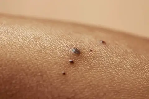 Zbliżenie na skórę z kilkoma ciemnymi znamionami, w tym jedno większe, które może być czerniakiem guzkowym.