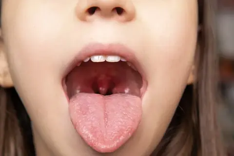 Zbliżenie na otwarte usta dziecka z widocznym językiem i migdałkami. W tle rozmyte wnętrze gardła, gdzie może być widoczny rak migdałka.