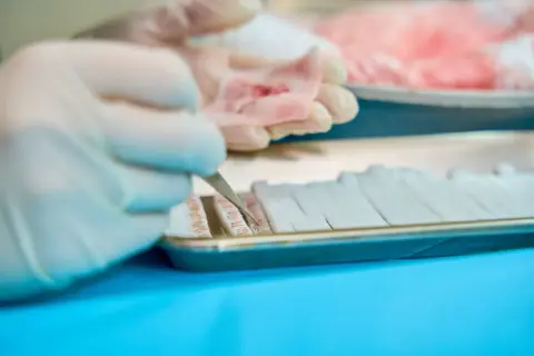Ręce w rękawiczkach przygotowują próbki tkanki do analizy. Wynik biopsji gruczolakowłókniak jest kluczowy dla dalszego leczenia.