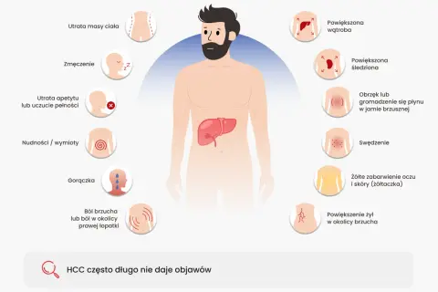 Ilustracja przedstawia objawy raka wątrobowokomórkowego (HCC), w tym utratę masy ciała, zmęczenie, ból brzucha i powiększoną wątrobę. Guz klatskina może objawiać się podobnie.