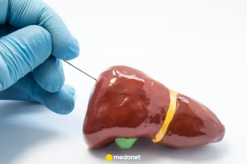 Rękawiczka w niebieskiej rękawiczce delikatnie wprowadza biopsja gruboigłowa igła do modelu wątroby.