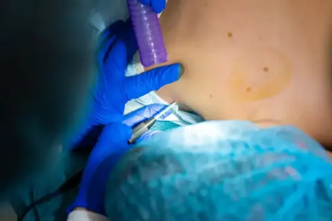 Lekarz w niebieskich rękawiczkach wykonuje biopsję aspiracyjną, pobierając próbkę tkanki z szyi pacjenta.