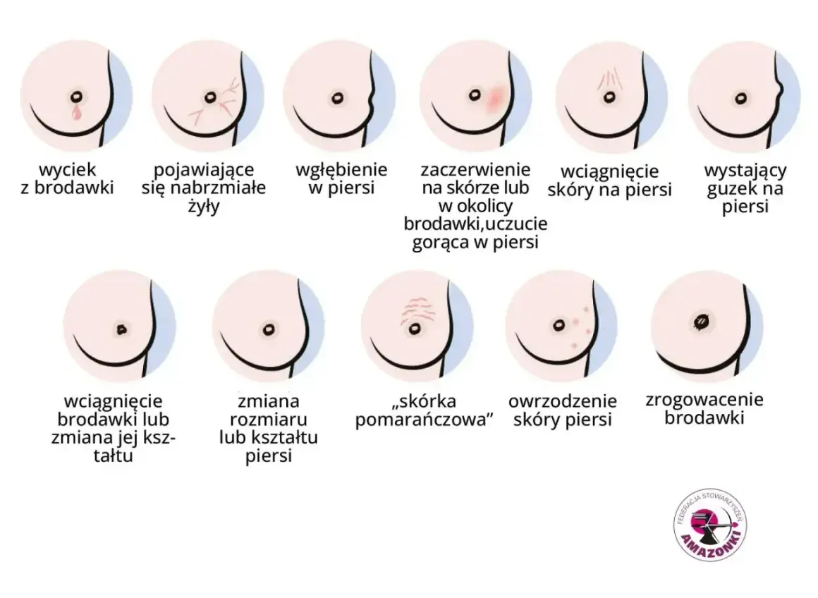 Ilustracja pokazuje różne zmiany w piersiach, w tym wyciek z brodawki, zaczerwienienie, wgłębienie, guzek, zmiany skórne i zrogowacenie.