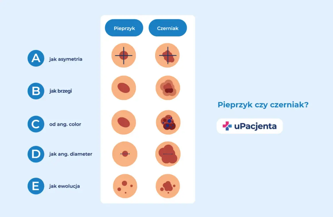 Ilustracja porównuje pieprzyk i czerniak, pokazując różnice w asymetrii, brzegach, kolorze, średnicy i ewolucji. Zwróć uwagę na czarną kropkę na sutku.
