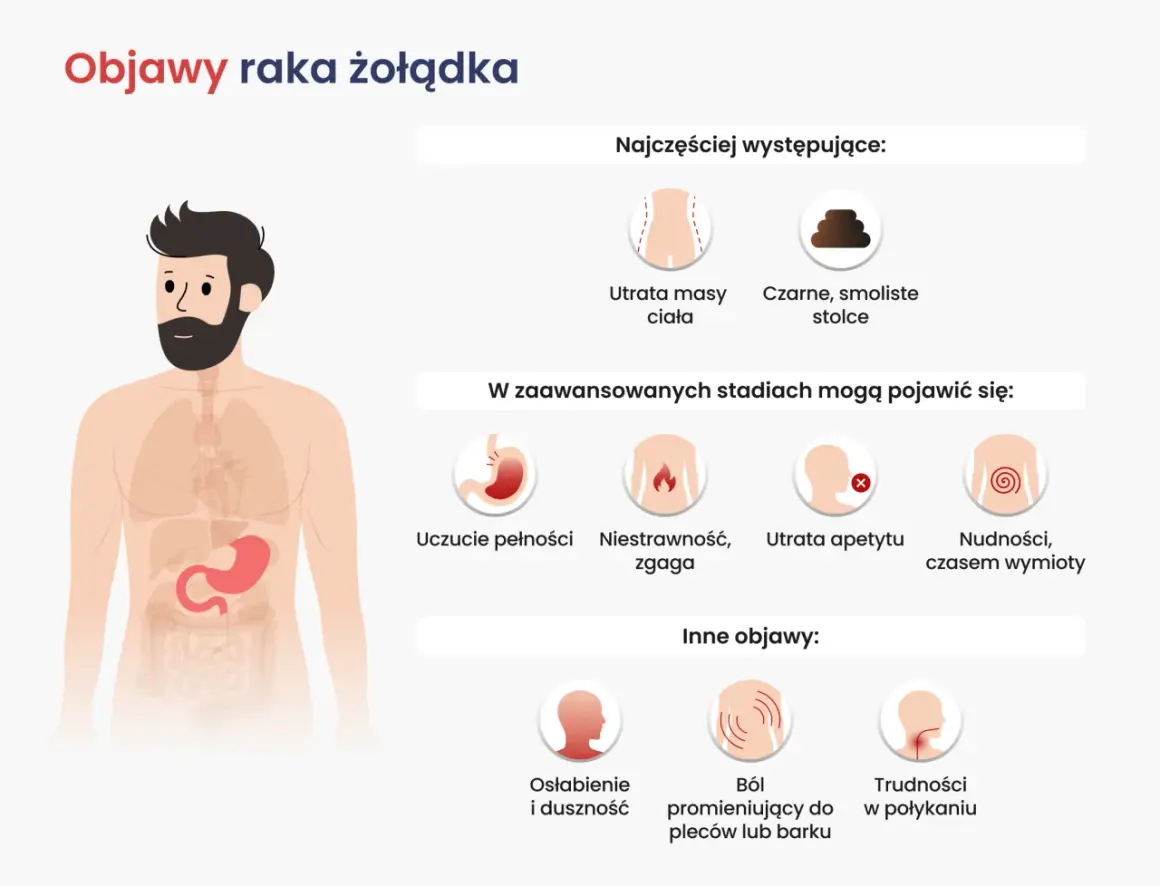 Ilustracja przedstawia objawy raka żołądka, w tym utratę masy ciała i czarne stolce. W zaawansowanych stadiach mogą pojawić się nudności, zgaga i trudności w połykaniu.