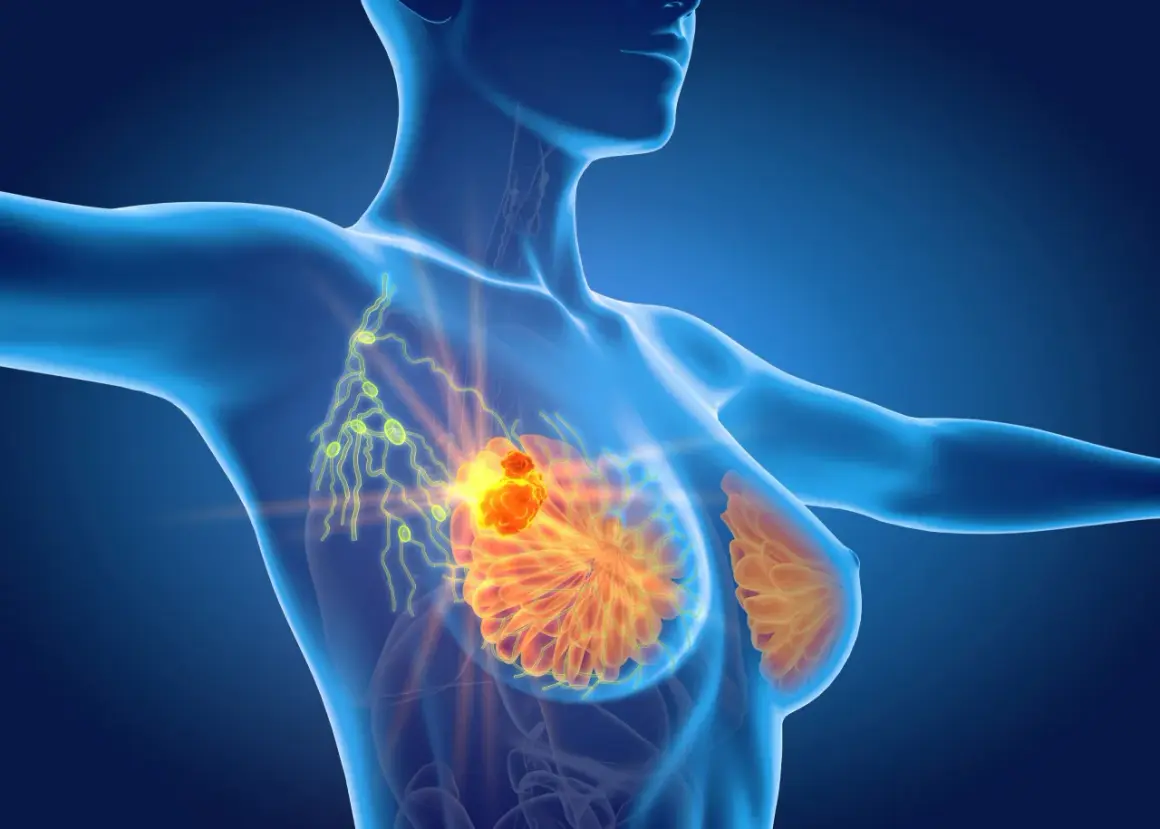 Anatomical view of a breast showing a tumor and affected wezly chlonne piersi.