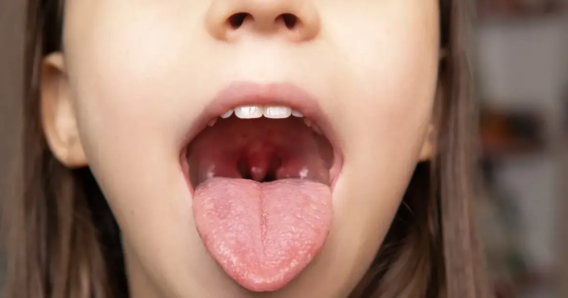Zbliżenie na otwarte usta dziecka z widocznym językiem i migdałkami. W tle rozmyte wnętrze gardła, gdzie może być widoczny rak migdałka.