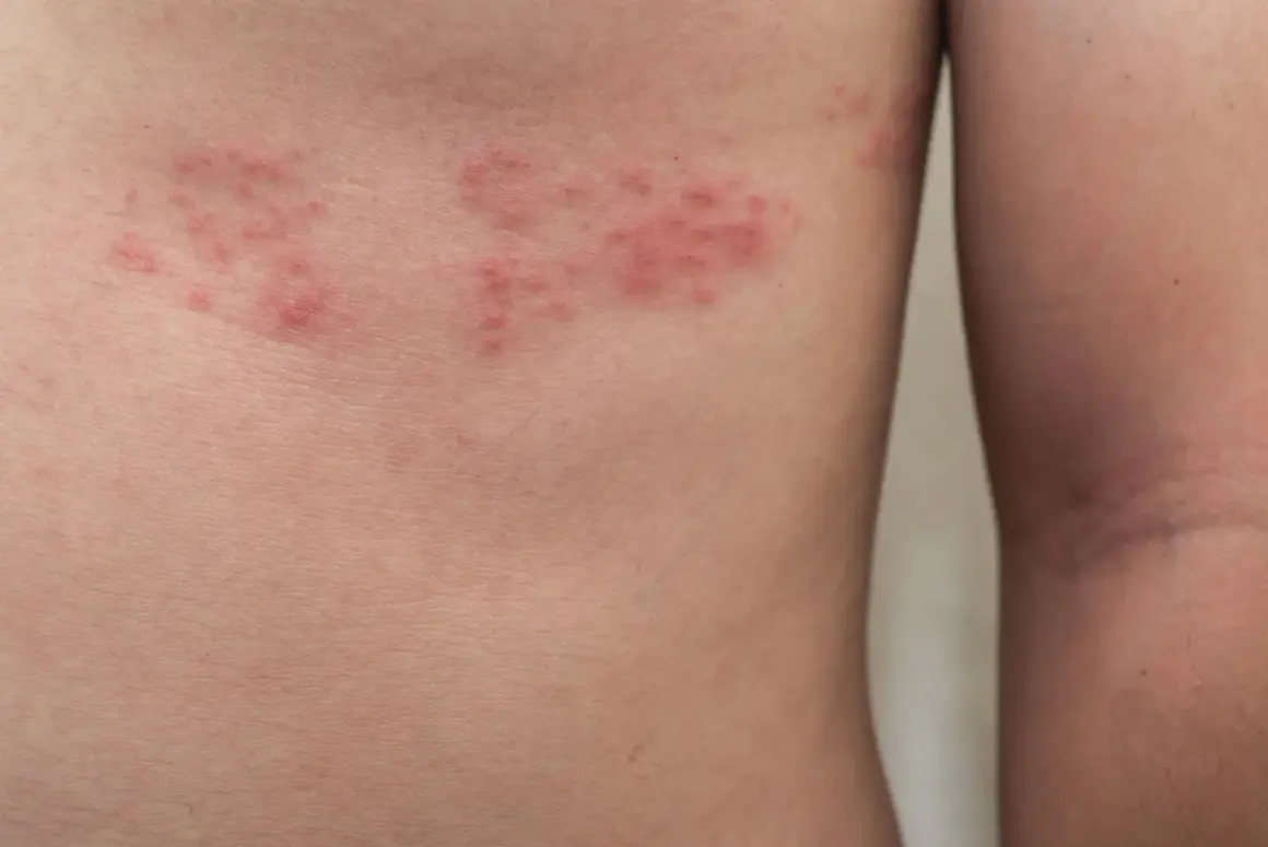 Czerwone, swędzące zmiany skórne na tułowiu. Czy półpasiec sygnalizuje nowotwór? Warto skonsultować się z lekarzem.