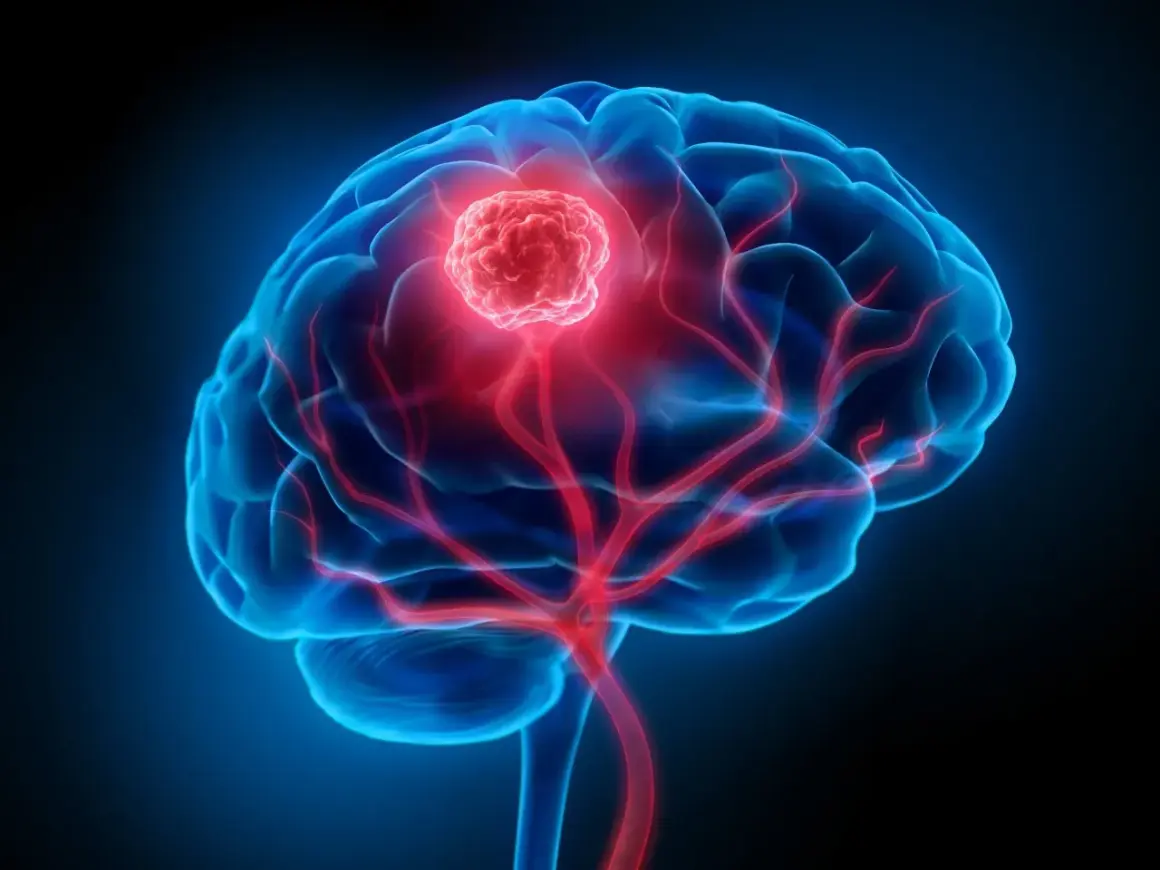Niebieski mózg z czerwonym, pulsującym guzem. Widoczny oponiak mózgu, który rozrasta się, naciskając na naczynia krwionośne.