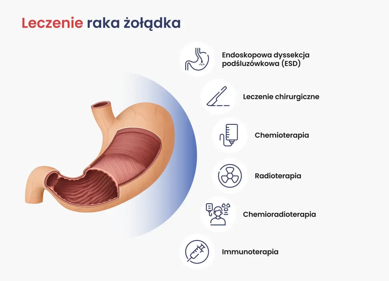 Ilustracja przedstawia przekrój żołądka i metody leczenia, w tym endoskopową dysseksję podśluzówkową (ESD), chirurgię, chemioterapię, radioterapię, chemioradioterapię i immunoterapię, stosowane w walce z gruczolakorakiem żołądka.