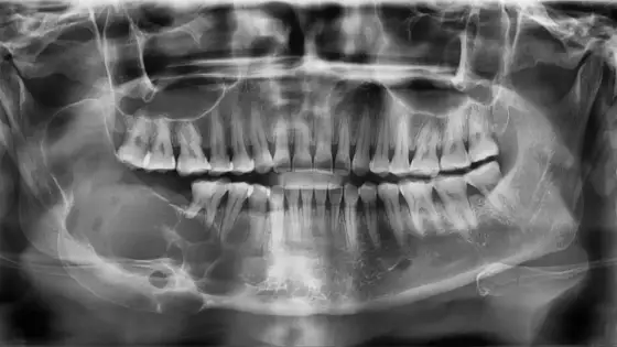 Rak zatoki szczękowej - objawy, diagnostyka i leczenie